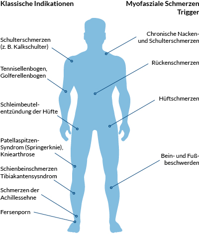 Behandlungsbereiche der Stoßwellentherapie