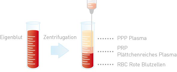 Blutentnahme bei Eigenblutbehandlung