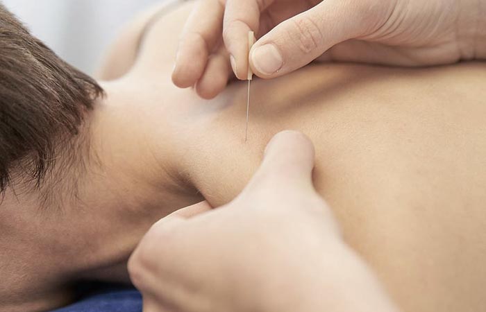 Dry Needling