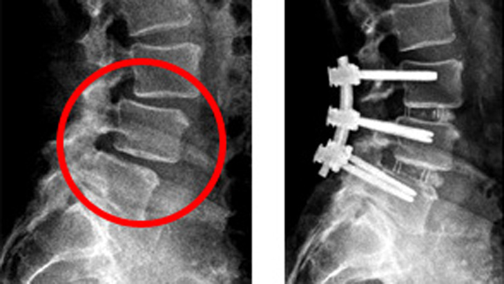 Versteifungsoperation Wirbelsäule bei Spondylolisthese