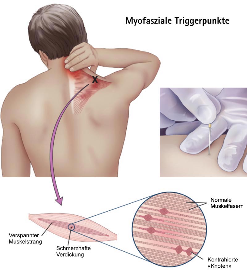 Myofasziale Triggerpunkte